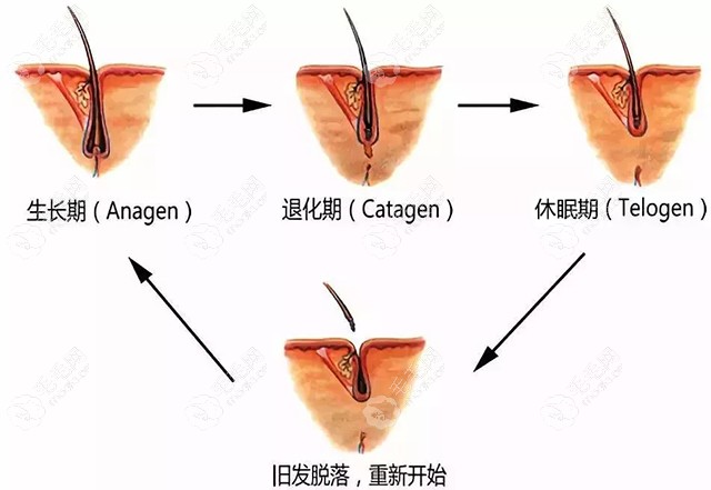 植发失败了会有怎样的后果,是后枕部的取发区变秃还是...