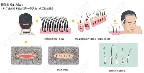 FUT植发技术操作流程