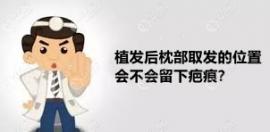植發(fā)比較擔心后枕部取發(fā)的位置留下疤痕又想告別大腦門子~