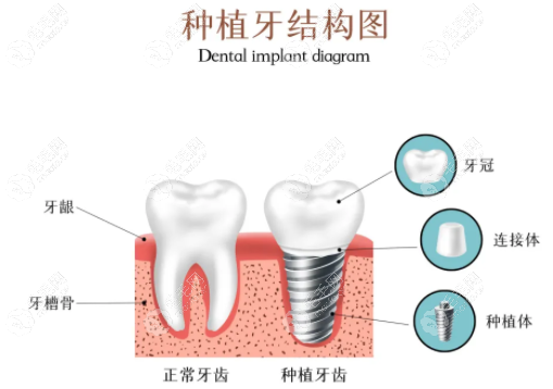 半口牙缺失较好的治疗方案是种4颗或6颗?5颗也可恢复上半口