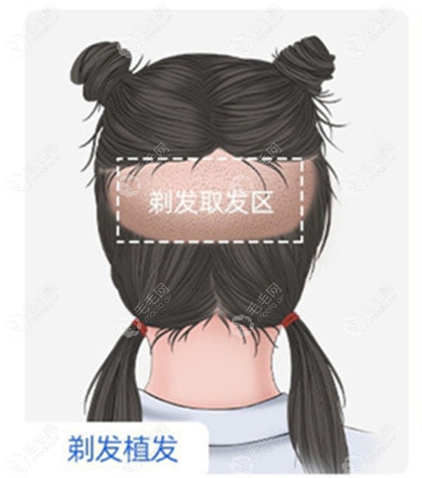 姐妹们植发后剪短发后枕部会难看吗？能看出来后脑勺不？