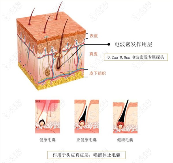 激光生发的原理示意图