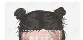 姐妹們植發(fā)后剪短發(fā)后枕部會(huì)難看嗎？能看出來后腦勺不？