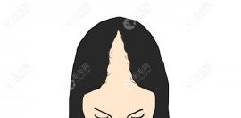 青年女性头顶圣诞树式脱发如何治疗才能长回来呀