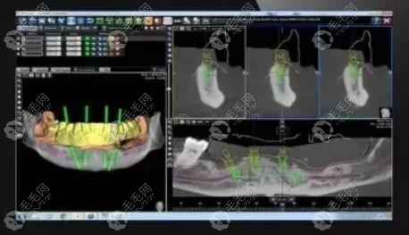 3D数字化导板种植牙的利和弊