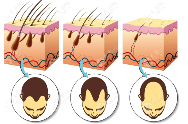 毛囊移植手术种植原理