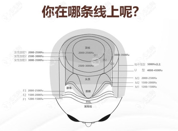 参考下，看你的脱发情况需要大概需要植多少单位