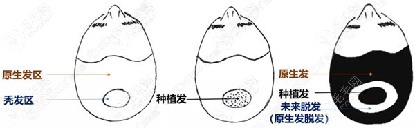 植发后使用SKM密发小棕瓶养护原生发