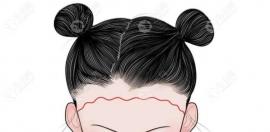 成都有FUE和微针植发技术的医院是哪几家?地址/费用我都需要