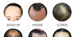 新疆烏魯木齊植發(fā)一個(gè)毛囊價(jià)格,列出FUE/微針/不剃發(fā)植發(fā)價(jià)