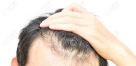 cgf治療脫發(fā)注射幾次見(jiàn)效?若用cgf生發(fā)治療半年后能維持多久