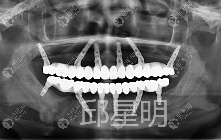 全口allon6种植牙