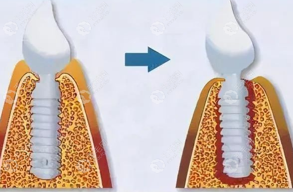 种植牙周围炎示意图