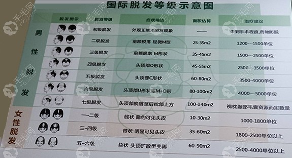 植发3000个毛囊单位有多宽要看四五级脱发的植发面积有多大