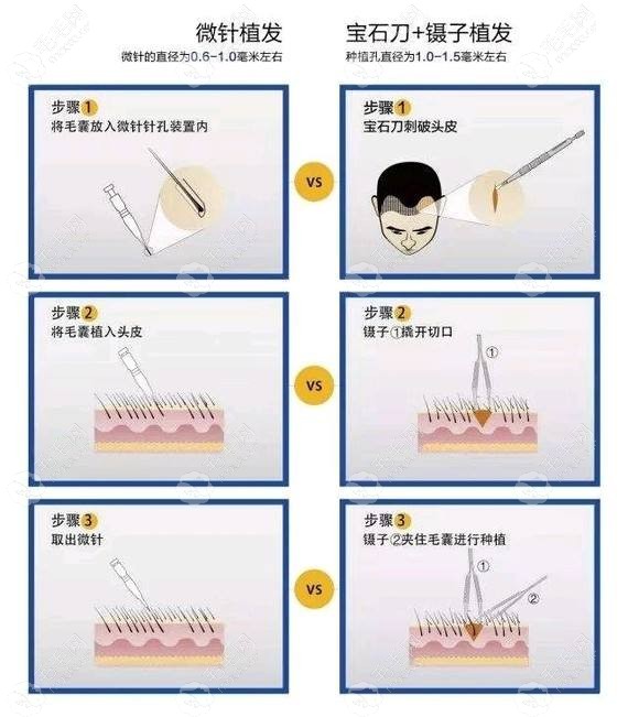 fue与微针技术对比图示