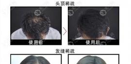 增發(fā)纖維一次能維持多久,他會堵塞毛孔對頭皮有害?