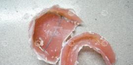 满口假牙哪种比较舒服？普通义齿、吸附性义齿还是种植牙