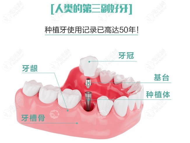 种植牙的组成及寿命