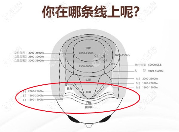 脱发区域对照示意图