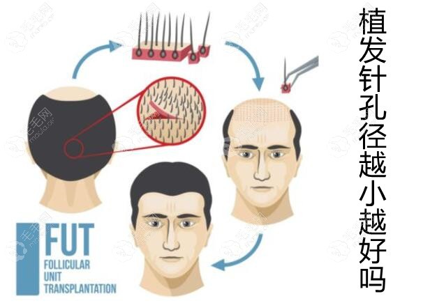 植发针孔径越小越好吗