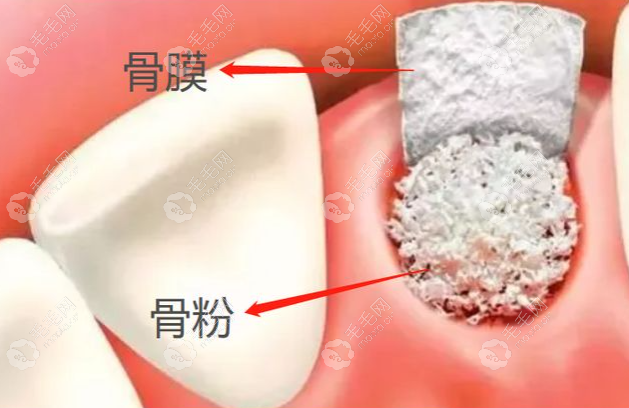 原来门牙种植不一定要加骨粉但风险和难度蛮大的