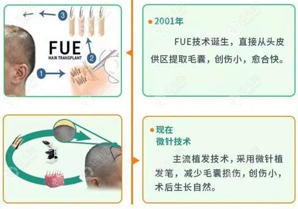 植发技术的不同是更先进的区别