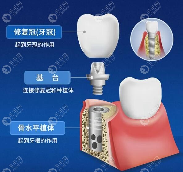 种植牙基台用什么材料好?纯钛OR全瓷、合金基台