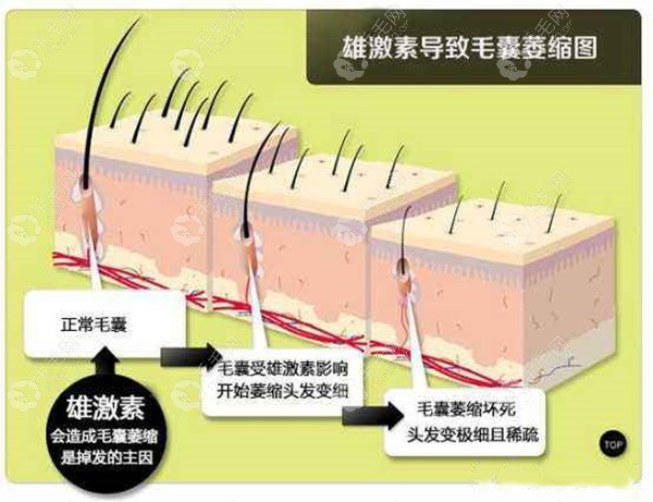 雄激素导致毛囊萎缩图