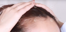 二级颅顶脱发怎么办?植发能治脱还会让颅顶变高头发变蓬松