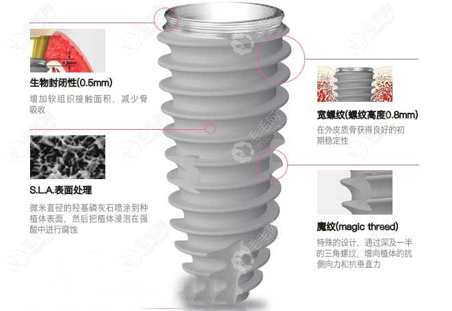 速览韩国纽百特植体有多少型号,表面喷砂材质可加快骨愈合