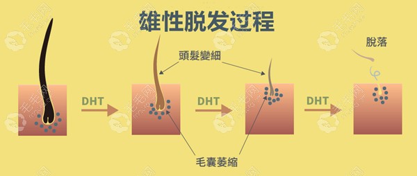 雄性脱发过程