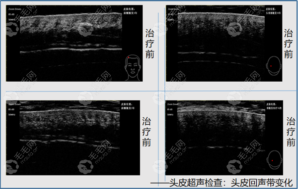 肯波迪毛囊活化仪真的能有效生发吗