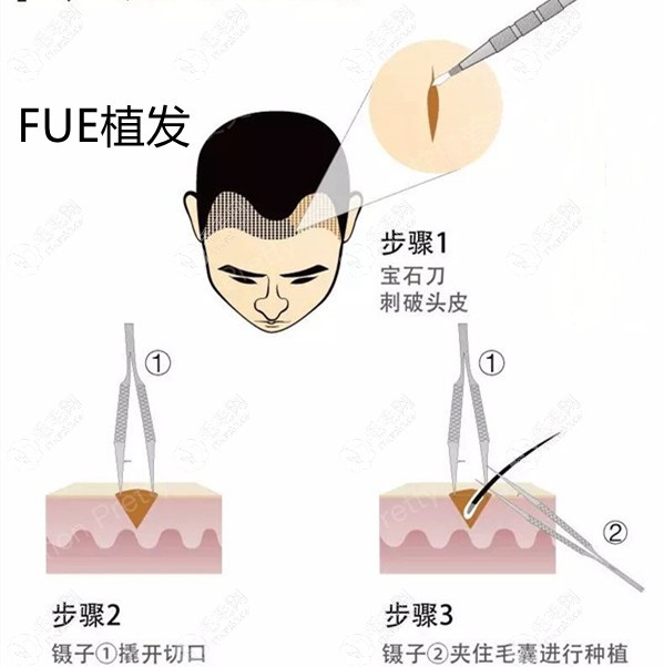 FUE植发