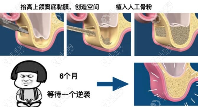 上颌窦提升的适应症