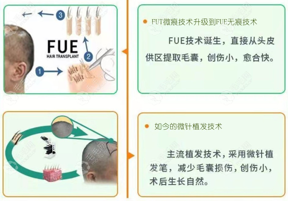 微针与fue技术的对比