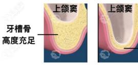 解疑:上半口种植牙前为什么要做上颌窦内外提升手术