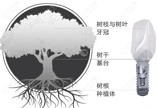 韩国三大种植体比较—登腾、奥齿泰、纽百特均是几级钛？