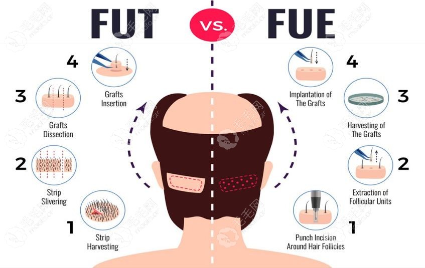 FUT植发和FUE的区别