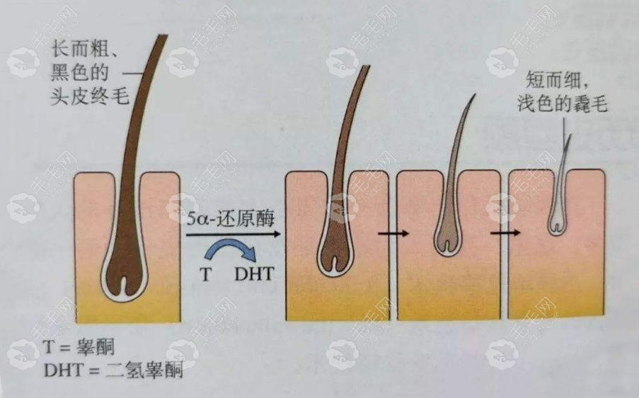 致脱雄激素二氢睾酮会让头发越来越细软，但是后脑勺头发不会