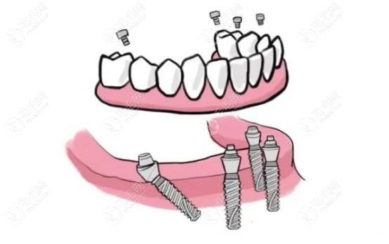 半固定种植牙的费用