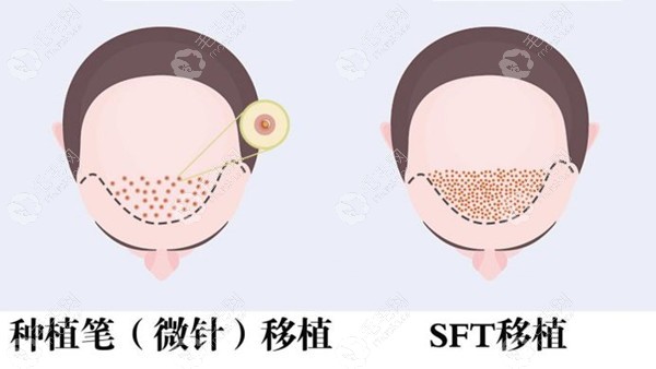 SFT毛发移植术密度高