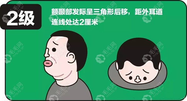 南宁二级脱发示意图