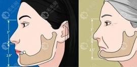 其实糖尿病人也能植满口牙,控制好血糖后风险不算大