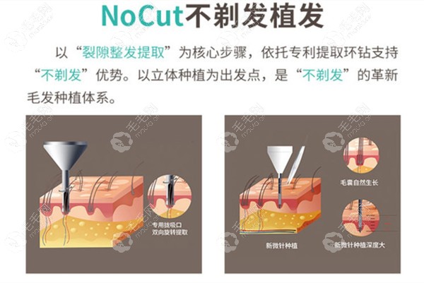 新生Nocut不剃发植发优势