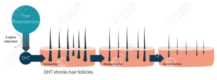 女雄性激素脱发不建议做植发的原因