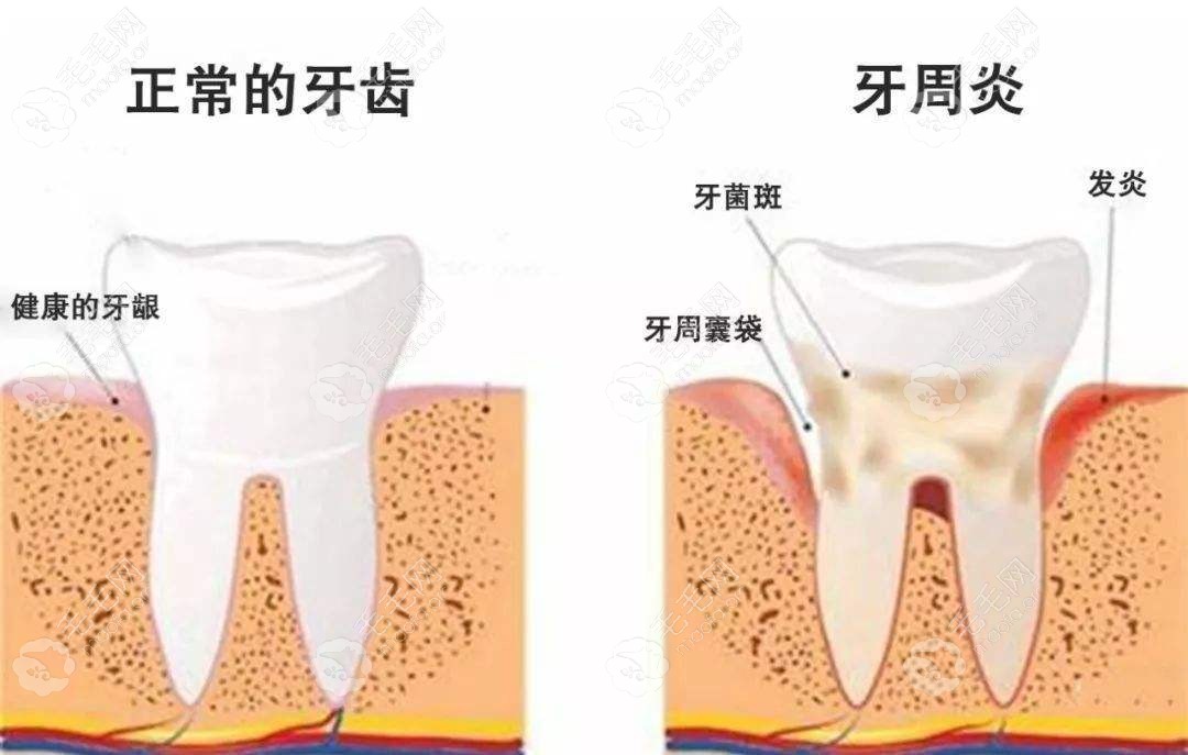 正常牙齿和牙周炎的对比