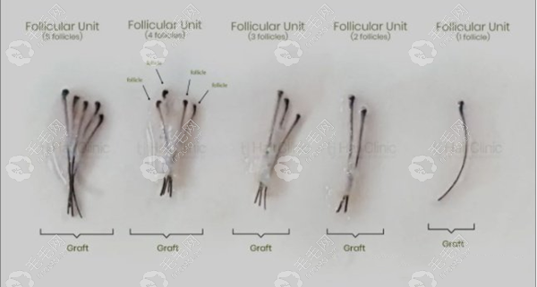毛囊种植根数图解