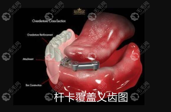 杆卡种植覆盖义齿图片