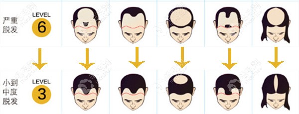 6级脱发植发3000单位改善形象