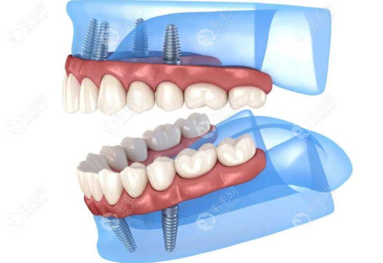 满口种植牙